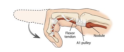 Trigger Finger | Iranian Surgery