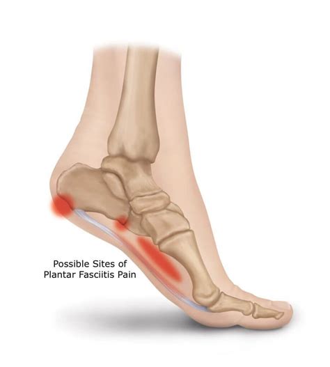 The Consequences of Leaving Plantar Fasciitis Untreated - Plantar Fasciitis