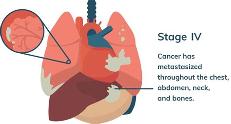 Malignant Mesothelioma Cancer | Stages, Prognosis, Treatment