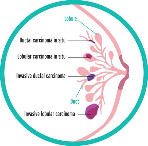 Common types of Breast Cancer presentations - Emabal Hospitals Limited