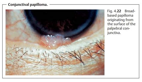 Conjunctiva Tumors