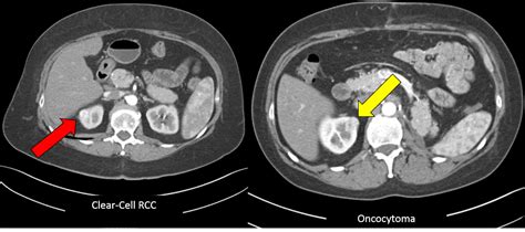 Brady Urology at Johns Hopkins Hospital: Oncocytoma: A Benign Kidney ...