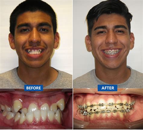 Braces Before And After Gap