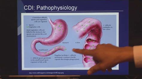 Fecal transplant helps patients of painful C.diff