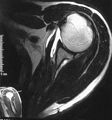 Rotator Cuff Tear Mri Arthrogram - cloudshareinfo