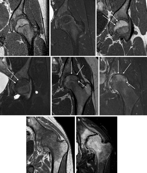 Femoral head bone marrow edema demonstrated on MRI of the left hip in ...