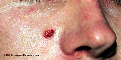 Skin Cancer Picture from UI Dermatology (Hardin MD / uIowa.edu)