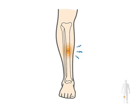 Squeeze test / syndesmosis injury,Stress fracture test / High ankle ...