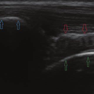 Longitudinal ultrasound image of a biceps tendon (red arrows ...