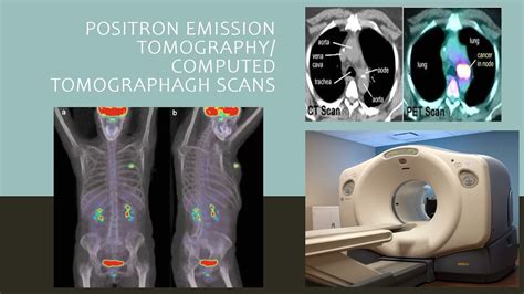 Positron Emission Tomography 2 - YouTube