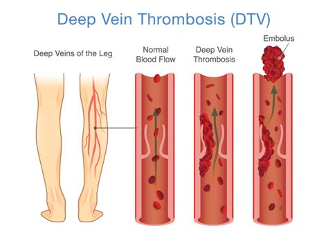 11 Tips for DVT Prevention - Preferred Vascular Group