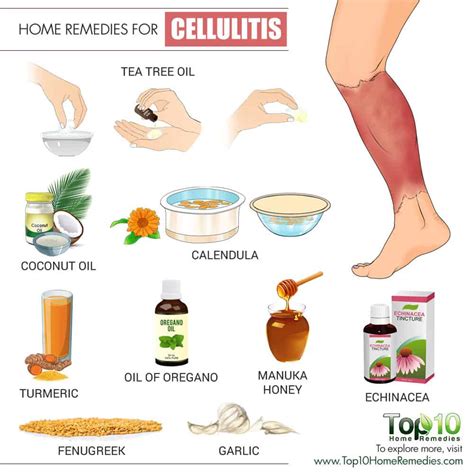 Home Remedies for Cellulitis | Top 10 Home Remedies