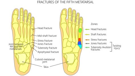 How To Help A Broken Foot - Documentride5