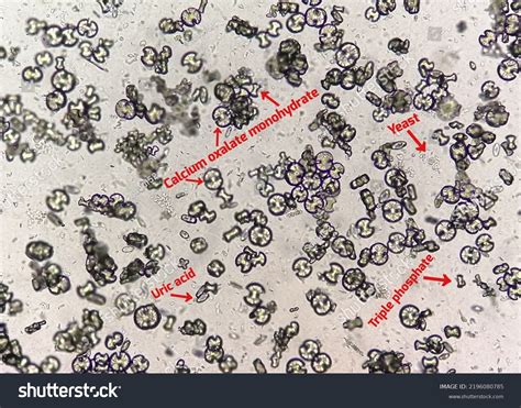 Calcium Oxalate Dihydrate Crystals In Urine