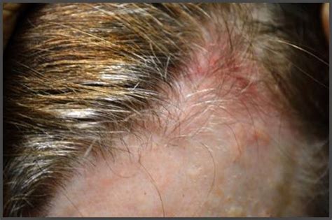 Pictures of shingles on the scalp | Shingles Expert