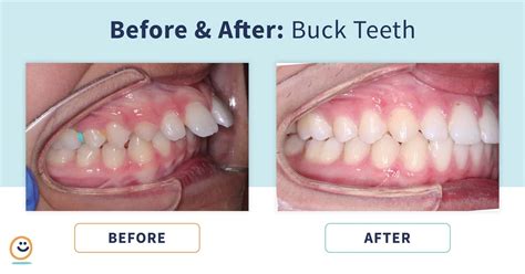 Braces: Before and After Buck Teeth