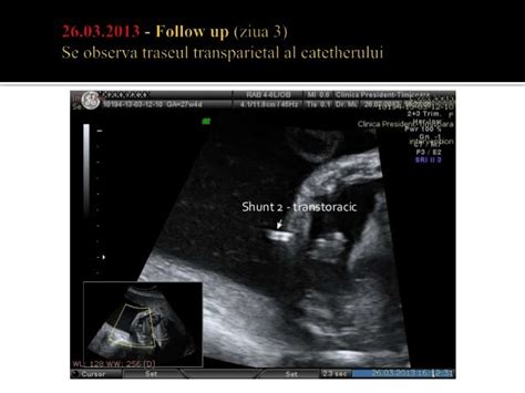 Hidrotorax fetal shunt pleuro amniotic