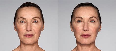 Restylane® Anti-Aging Injectable | Beverly Hills Medical Spa