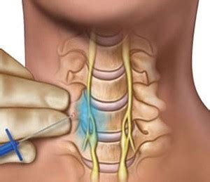 Stellate Ganglion Block | West Michigan Surgery Center