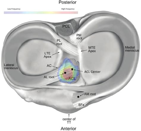 The native insertion of the anterior root of the lateral meniscus ...