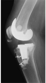 Harvesting Semitendinosus and Gracilis for Free Tendon Graft ...