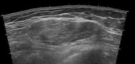 Lipoma Ultrasound Radiology