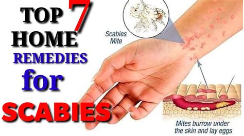 Http Scabiestricks Get Scabies Home Treatments And Post Scabies ...