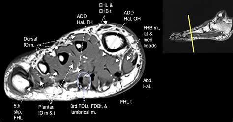 Plantar Foot Muscles Mri - MRI IN FOOT PAIN - 31 the plantar intrinsic ...