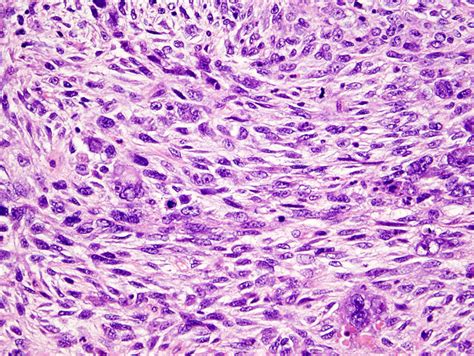 Malignant pleural mesothelioma subtypes