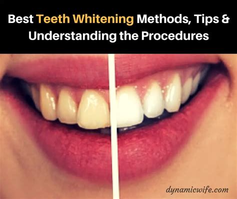 Best Teeth Whitening Methods, Tips & Procedures Explained!