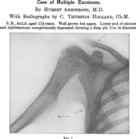 Figure 1 from Case of Multiple Exostoses | Semantic Scholar