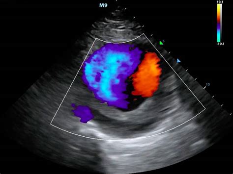 Colour Doppler | Megavision Diagnostics Centers