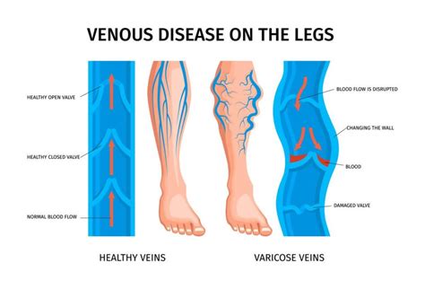 Chronic Venous Insufficiency: Causes, Symptoms And, 53% OFF