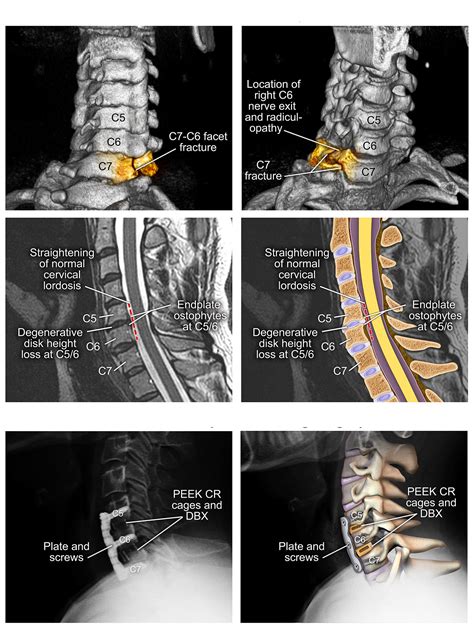 Medmovie.com | Cervical Spine Fractures and Surgical Fixation