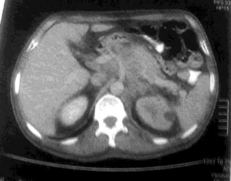 CT of the abdomen using pancreatic protocol. | Download Scientific Diagram