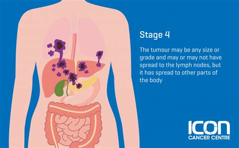 What is Soft Tissue Sarcoma? Soft Tissue Sarcoma Explained — Icon ...