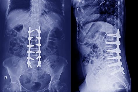 أمراض القرص التنكسية..التغيرات في العمود الفقري Degenerative Disc ...