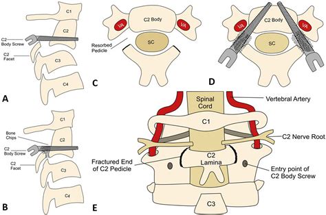 Management of neglected complex hangman’s fracture by reforming the C2 ...