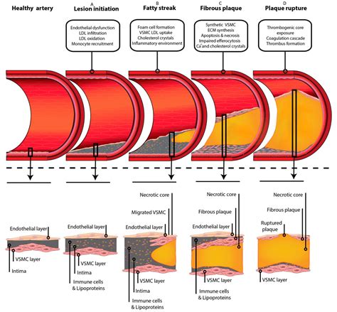 Atherosclerosis Diagram