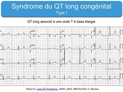 Long Qt Syndrome Ecg Pattern