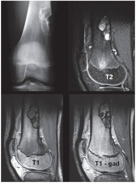 Benign Tumors and Tumor-like Lesions III: Fibrous, Fibroosseus, and ...