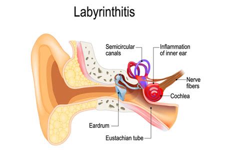 Labyrinthitis Symptoms and Treatment | Happy Ears Balance Center