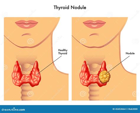 Thyroid nodule stock photo. Image of multiple, bloating - 45453664