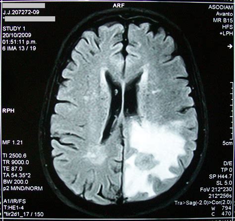 File:MRI brain tumor.jpg - Wikimedia Commons