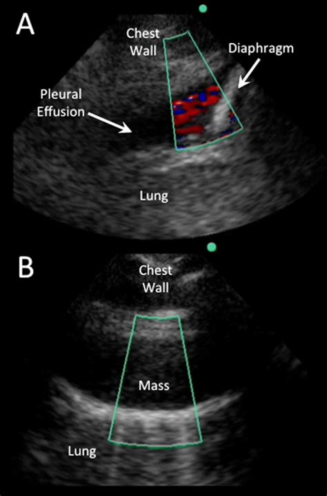 Ultrasound and Pleural Effusions | Journal of Hospital Medicine