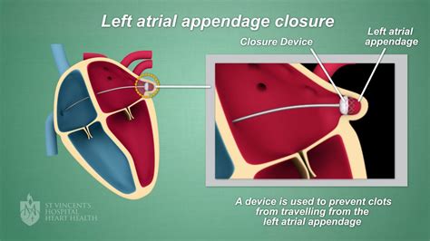 Left Atrial Appendage Closure - St Vincent's Heart Health