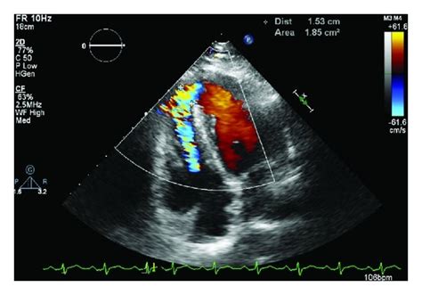 Transthoracic echocardiogram: apical ventricular septal defect with ...