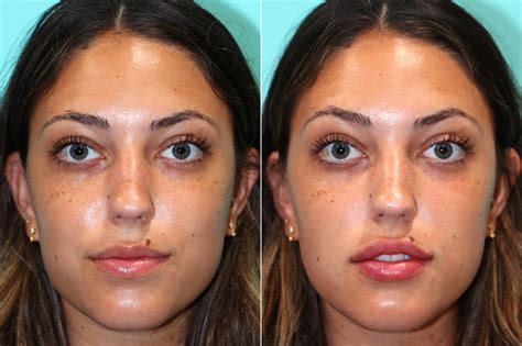 Lip Augmentation photos | Chevy Chase, MD | Patient 17568