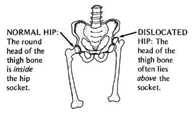 Hip flexors and sit ups good, hip dislocation symptoms in toddlers quiz ...