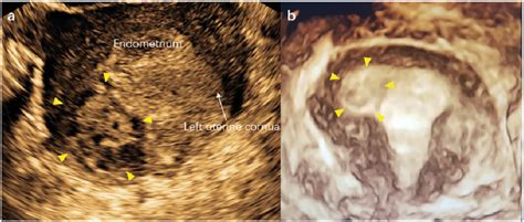 Figure 1 from Myomectomy scar pregnancy: a case report and review of ...